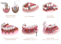 RESTAURACIONES MEDIANTES IMPLANTES DENTALES